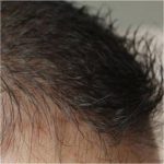 HR3, diodos con láser para tratar la alopecia